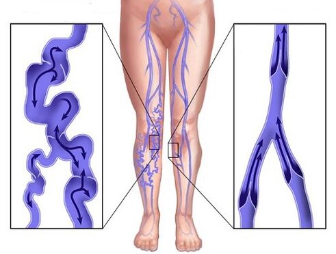 Comparación de las venas afectadas por varicosa y venas después del uso de ZXCVBNQWERT
