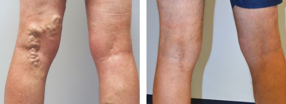 Fotos antes y después del uso de Veniselle, la experiencia del uso de la crema