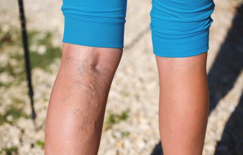 Daño a los extremos inferiores