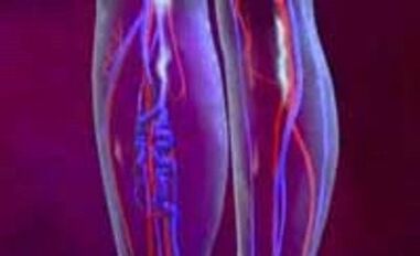 Causas y tratamiento de venas varicosas