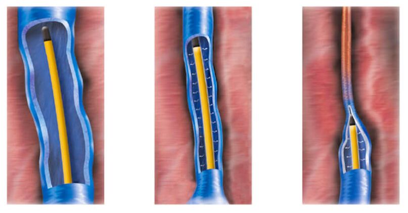 La ablación por radiofrecuencia como método de tratamiento de las varices.