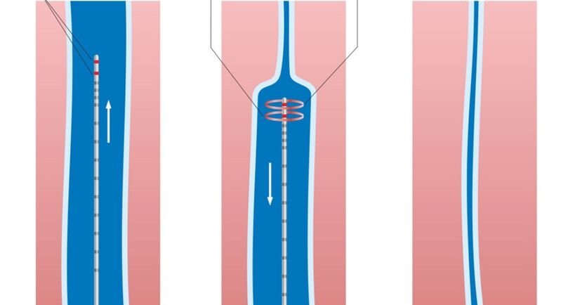 Tratamiento con láser para venas varicosas en las piernas.