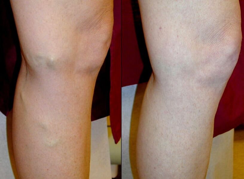 métodos de tratamiento de las venas varicosas en las piernas